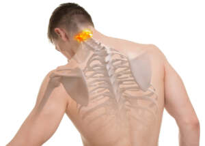 Das HWS-Syndrom betrifft die Halswirbelsäule und ruft Beschwerden im Hals- und Nackenbereich hervor
