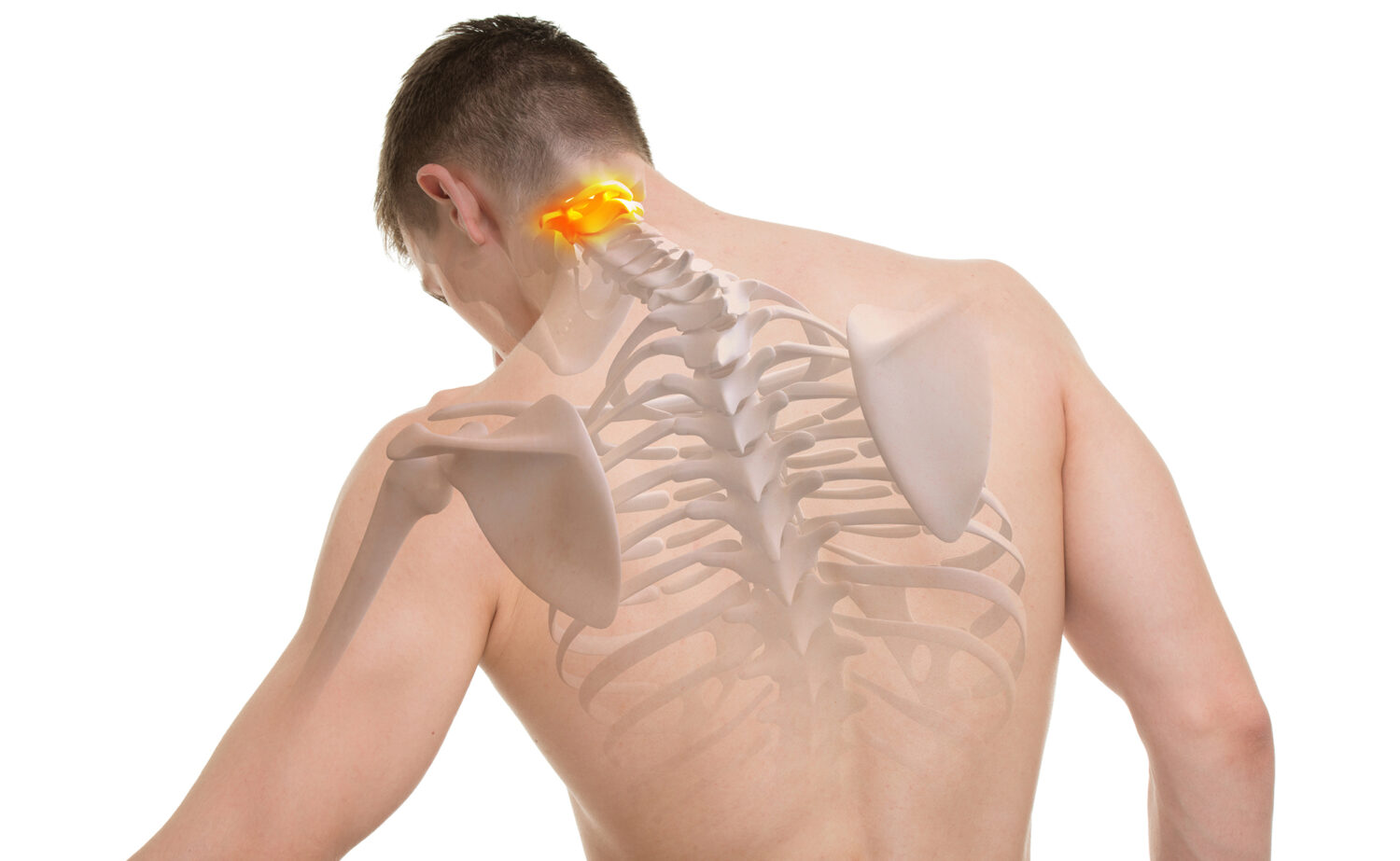 Das HWS-Syndrom betrifft die Halswirbelsäule und ruft Beschwerden im Hals- und Nackenbereich hervor